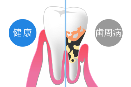 歯周病の進行と予防について